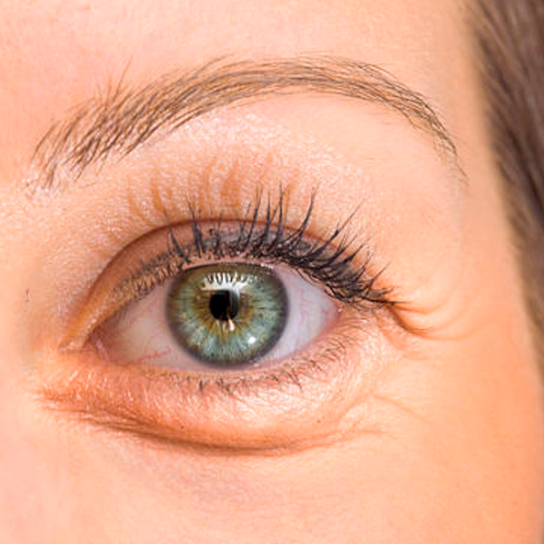 Blefaroplastia